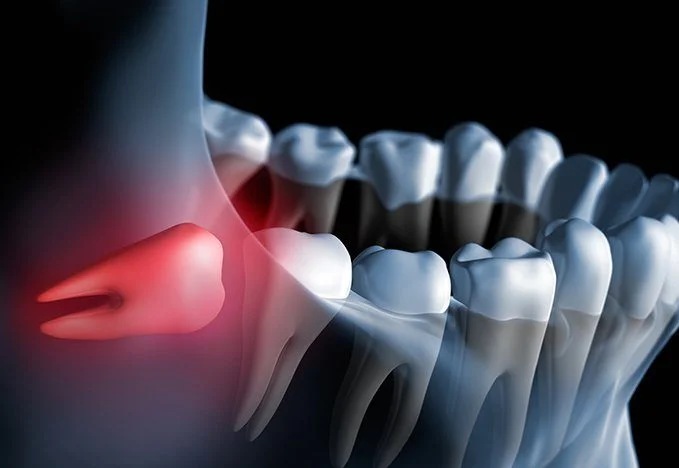Wisdom Tooth Extraction