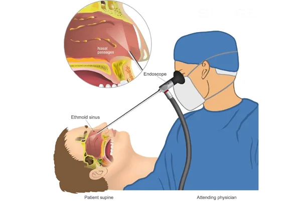 ENT Endoscopy